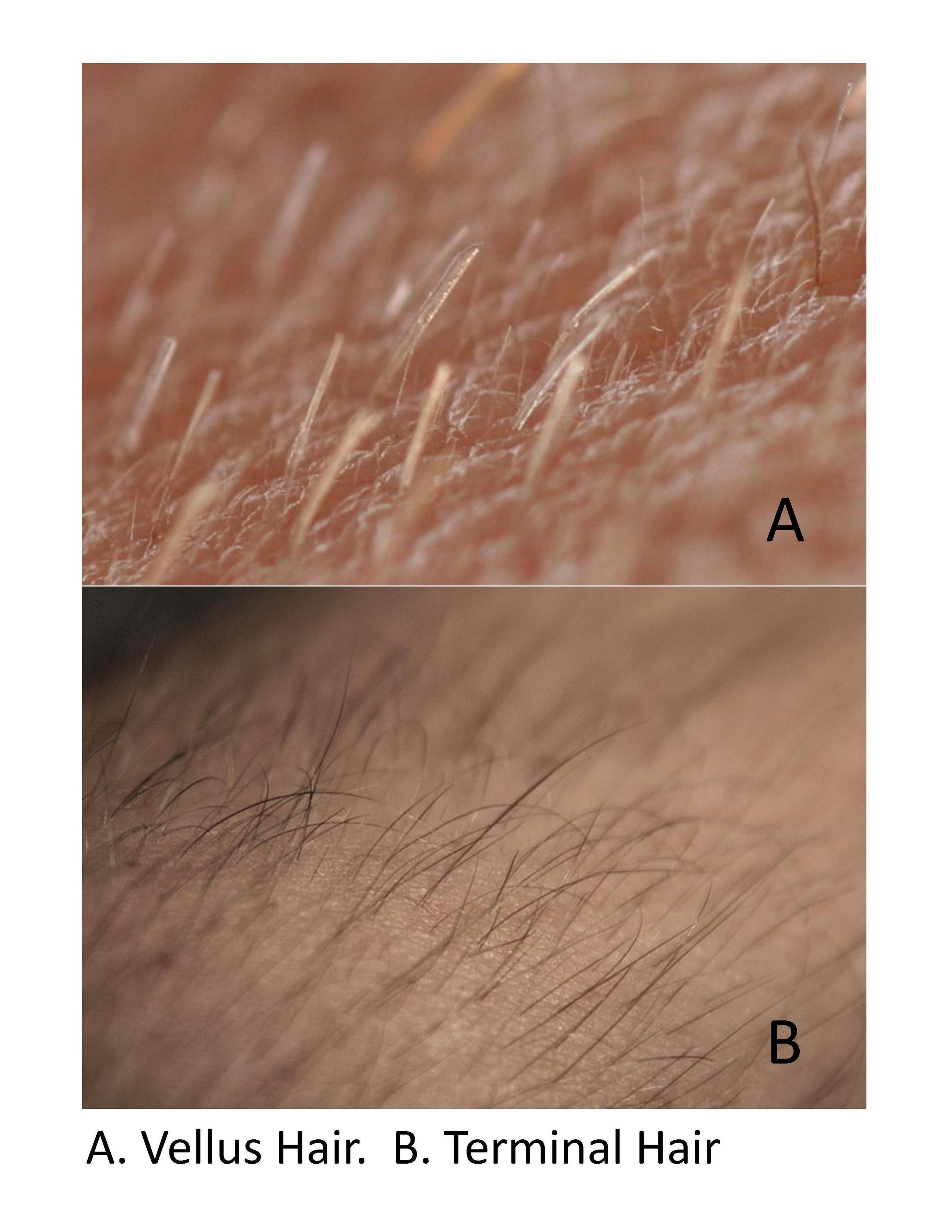 Terminal Hair Vs Vellus Hair