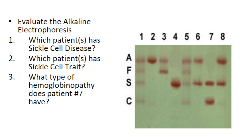 Hemoglobin Sc Disease Electrophoresis Pregnancy Depression   Php6ywjbF 