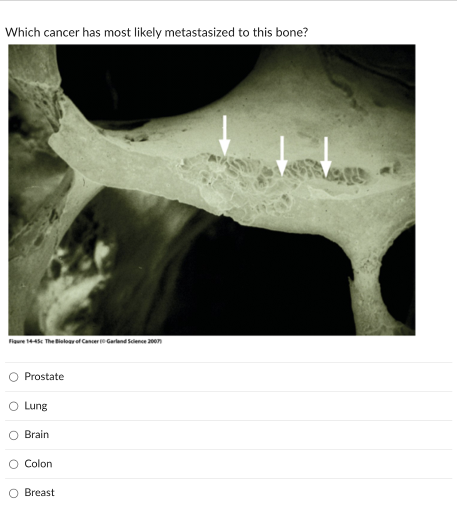 Solved Which cancer has most likely metastasized to this | Chegg.com