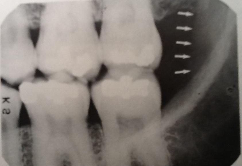 mylohyoid ridge radiograph