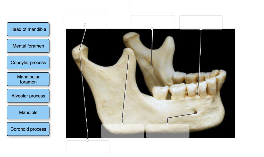 Solved Body of mandible Mandibular notch Ramus of mandible | Chegg.com