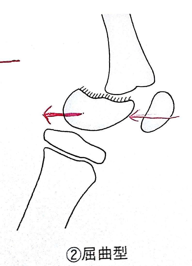 柔整各論 下肢の骨折 骨盤骨 膝蓋骨 Flashcards Chegg Com
