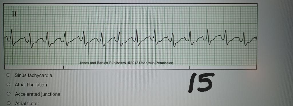 Sinus tachycardia
Atrial fibrillation
Accelerated junctional
Atrial flutter