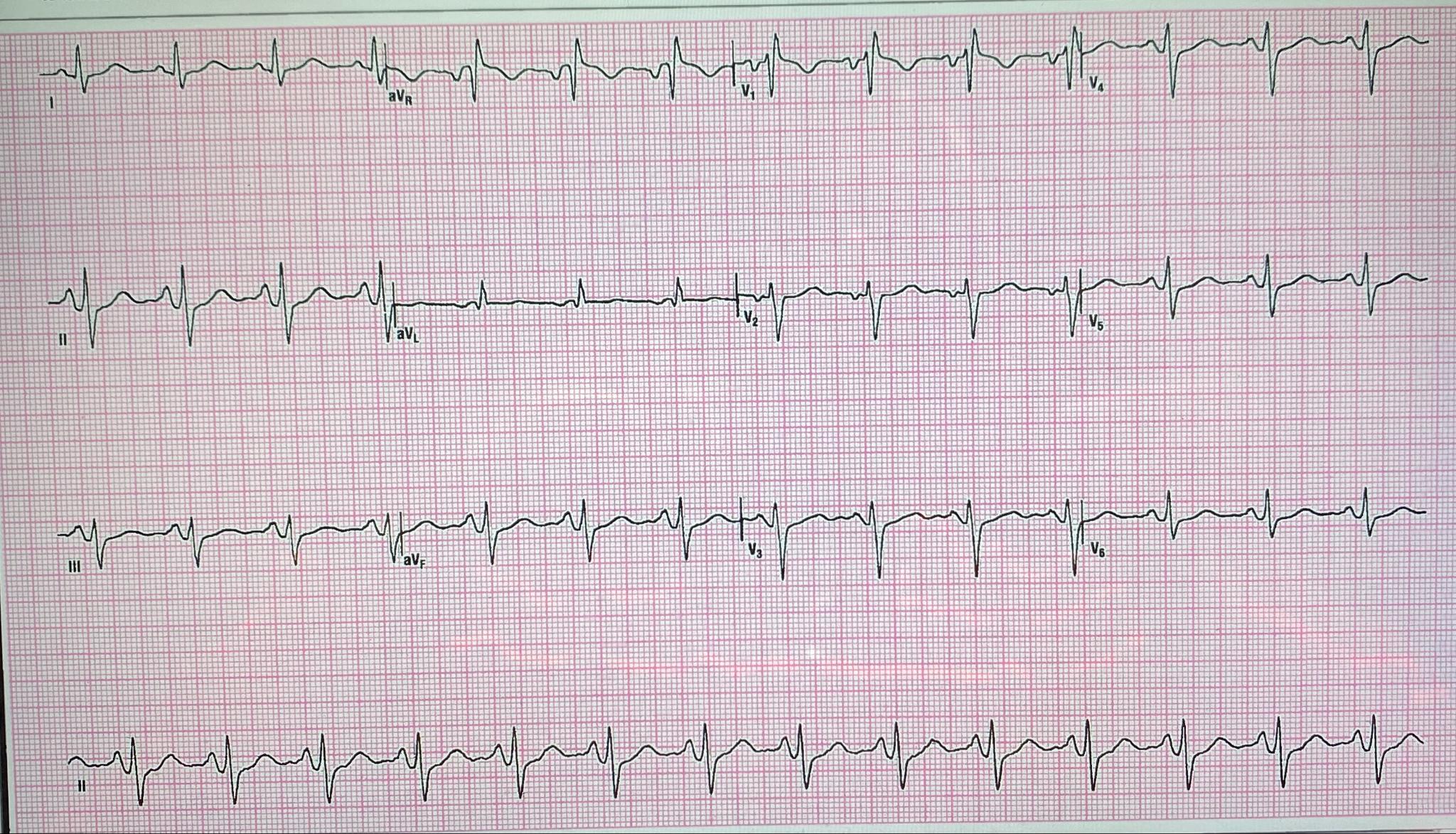 Solved ECG #2What does the ECG show?Is this a normal ECG or | Chegg.com