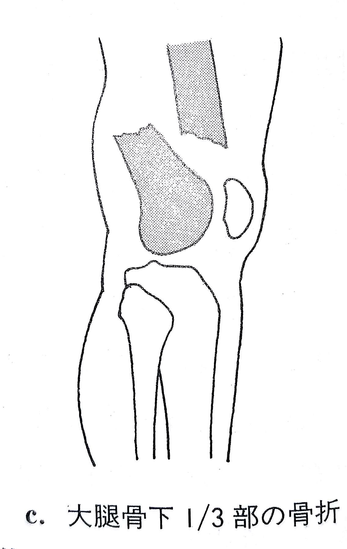 柔整各論 下肢の骨折 骨盤骨 膝蓋骨 Flashcards Chegg Com