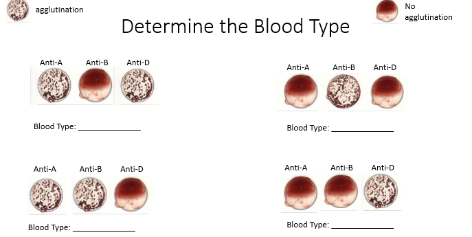 agglutination
Determine the Blood Type
Blood Type:
Blood Type:
Blood Type:
Blood Type: