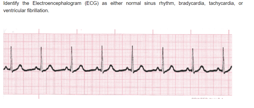 Solved Identify The Electroencephalogram (ECG) As Either | Chegg.com