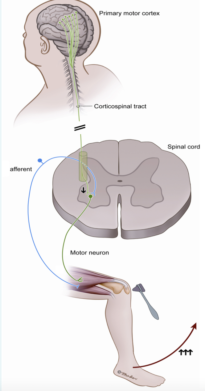 Solved A person with a recent spinal cord injury may not be | Chegg.com