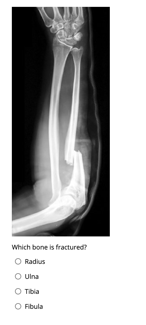 Solved Which bone is fractured? O Radius Ulna Tibia O Fibula | Chegg.com