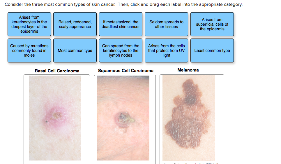 Solved Consider The Three Most Common Types Of Skin Cancer