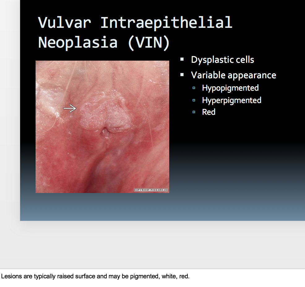 Vulvar Intraepithelial Neoplasia vin Vulvar Intraepithelial Neoplasia vin