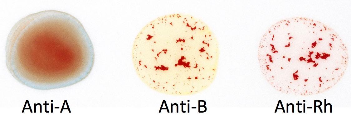 Solved Anti-A Anti-B Anti-Rh | Chegg.com