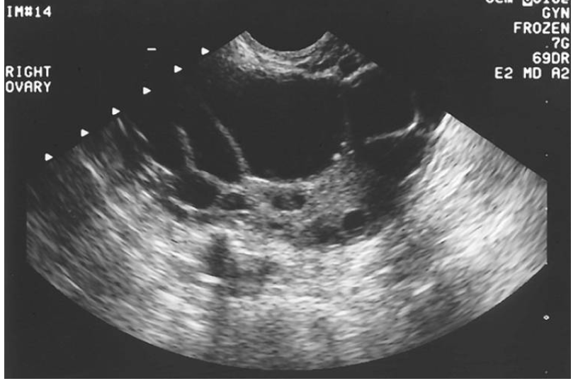 Solved What is the significant features of this ovarian | Chegg.com