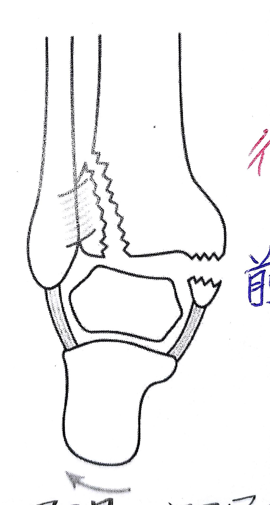 柔整各論 下肢の骨折 下腿骨 足指骨 Flashcards Chegg Com
