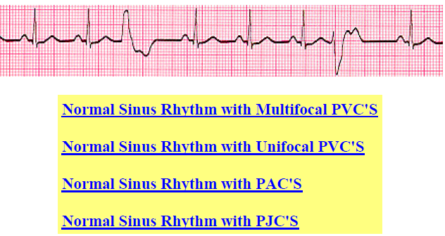 Acls 6 Second Rhythm Strips Flashcards Chegg Com