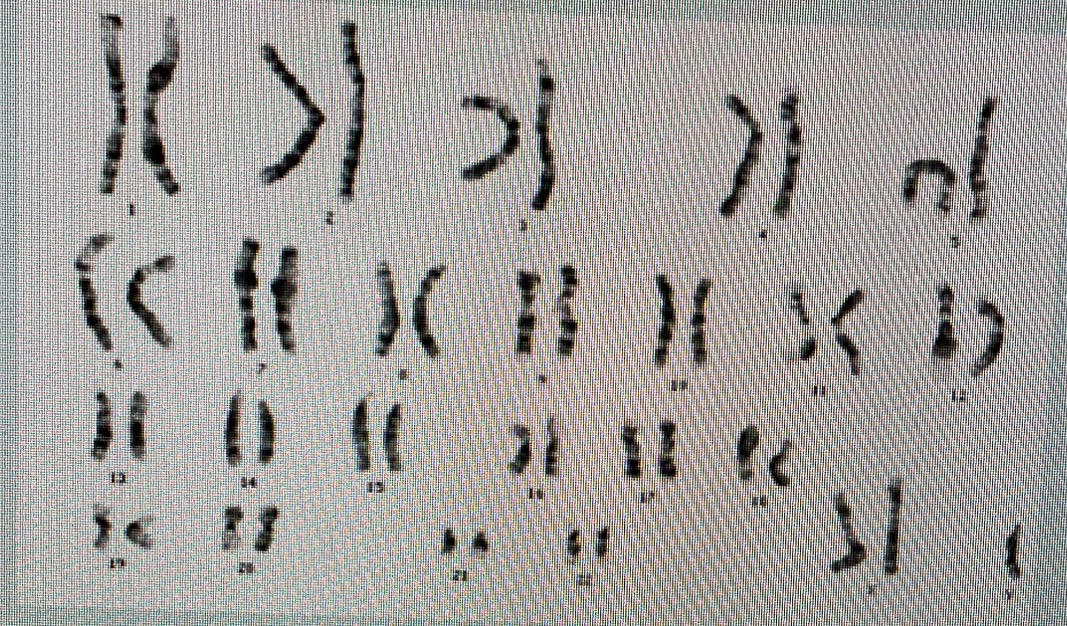 Solved A karyotype similar to the one shown below would be | Chegg.com