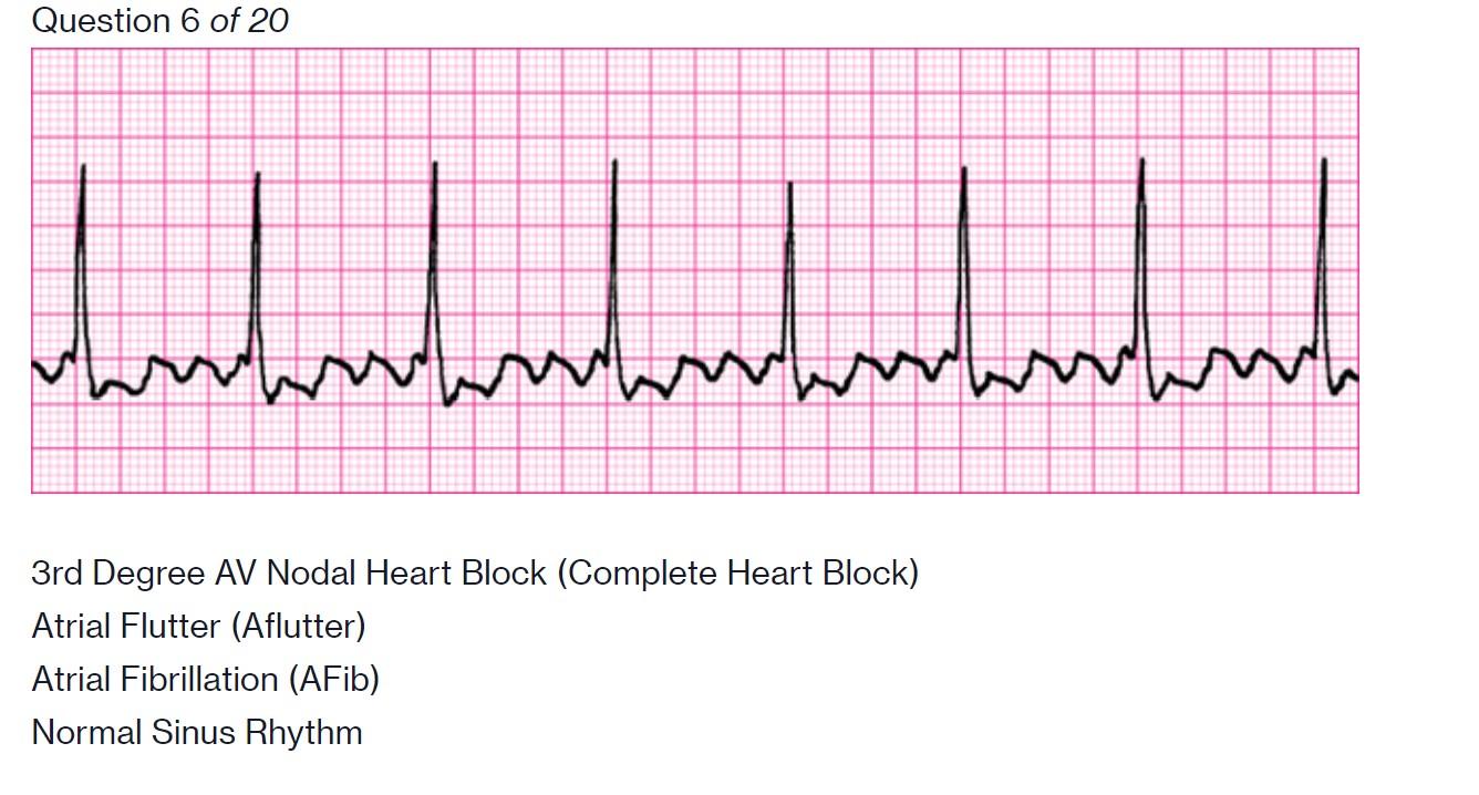 Solved Question 6 of 20 charm wh verum 3rd Degree AV Nodal | Chegg.com