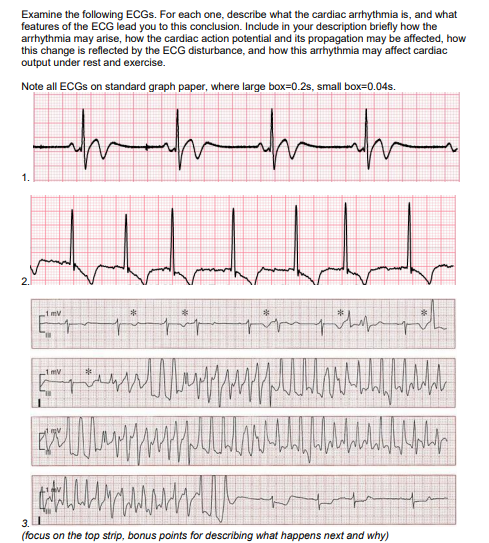 Solved Examine the following ECGs. For each one, describe | Chegg.com