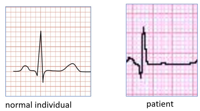 Solved Examine the electrocardiograms (ECG) depicted below. | Chegg.com