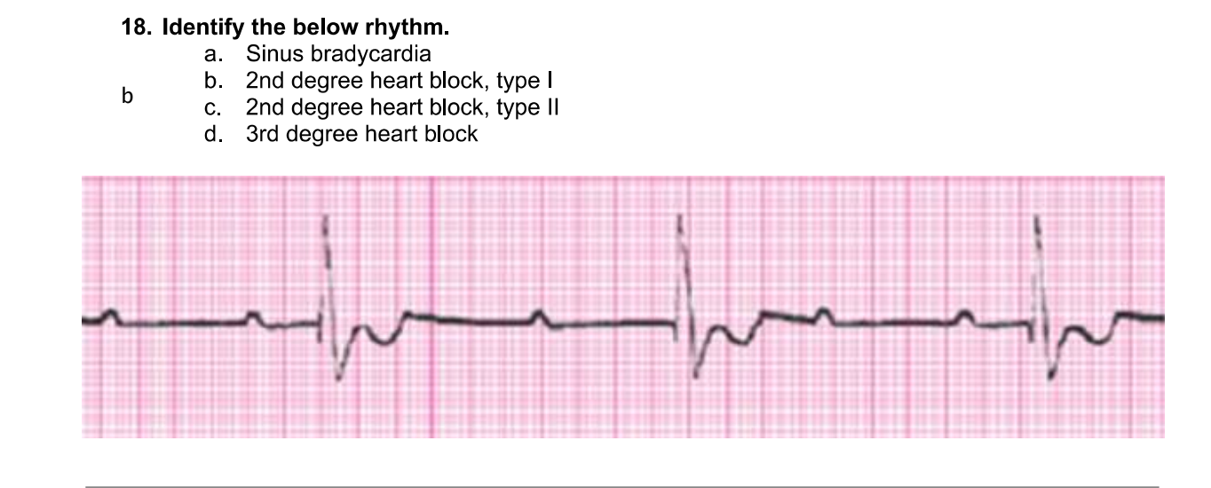 Solved 18. Identify the below rhythm. a. Sinus bradycardia | Chegg.com