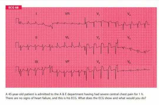 Solved ECG 68 VR V тану VL bermaisupport werythin VE V ve A | Chegg.com