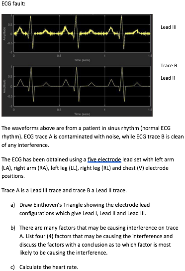 The waveforms above are from a patient in sinus rhythm (normal ECG rhythm). ECG trace A is contaminated with noise, while ECG