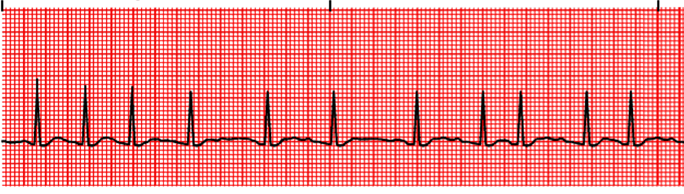 Solved What Is The Rhythm?        