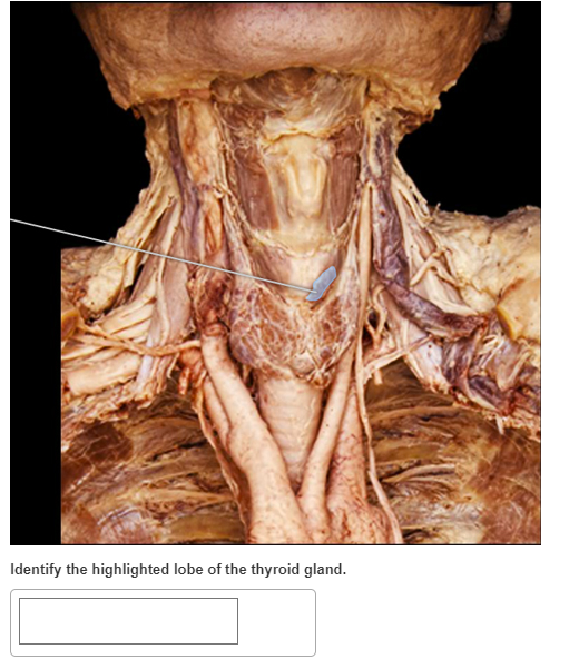 Identify the highlighted lobe of the thyroid gland.
