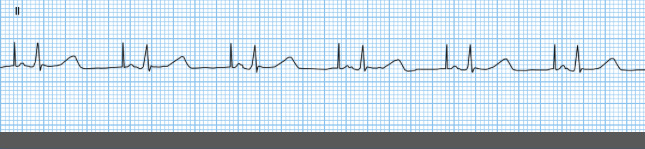 Analyze this AAI pacemaker strip. Identify any | Chegg.com