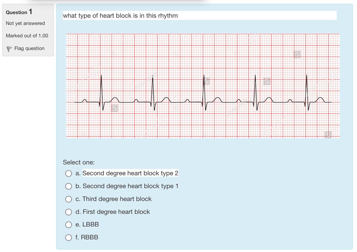 Solved Question 1 what type of heart block is in this rhythm | Chegg.com