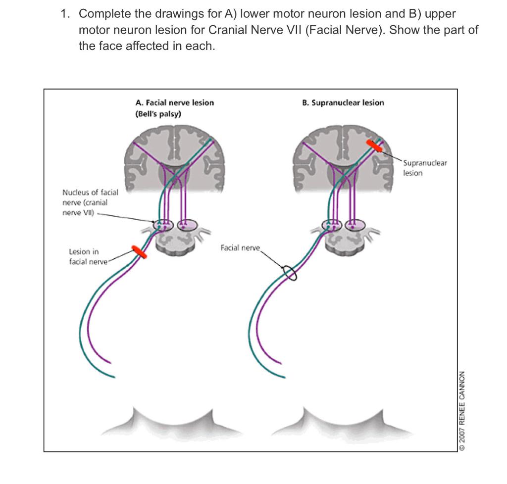 solved-1-complete-the-drawings-for-a-lower-motor-neuron-chegg