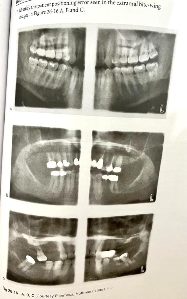 Identify the patient positioning error seen in the