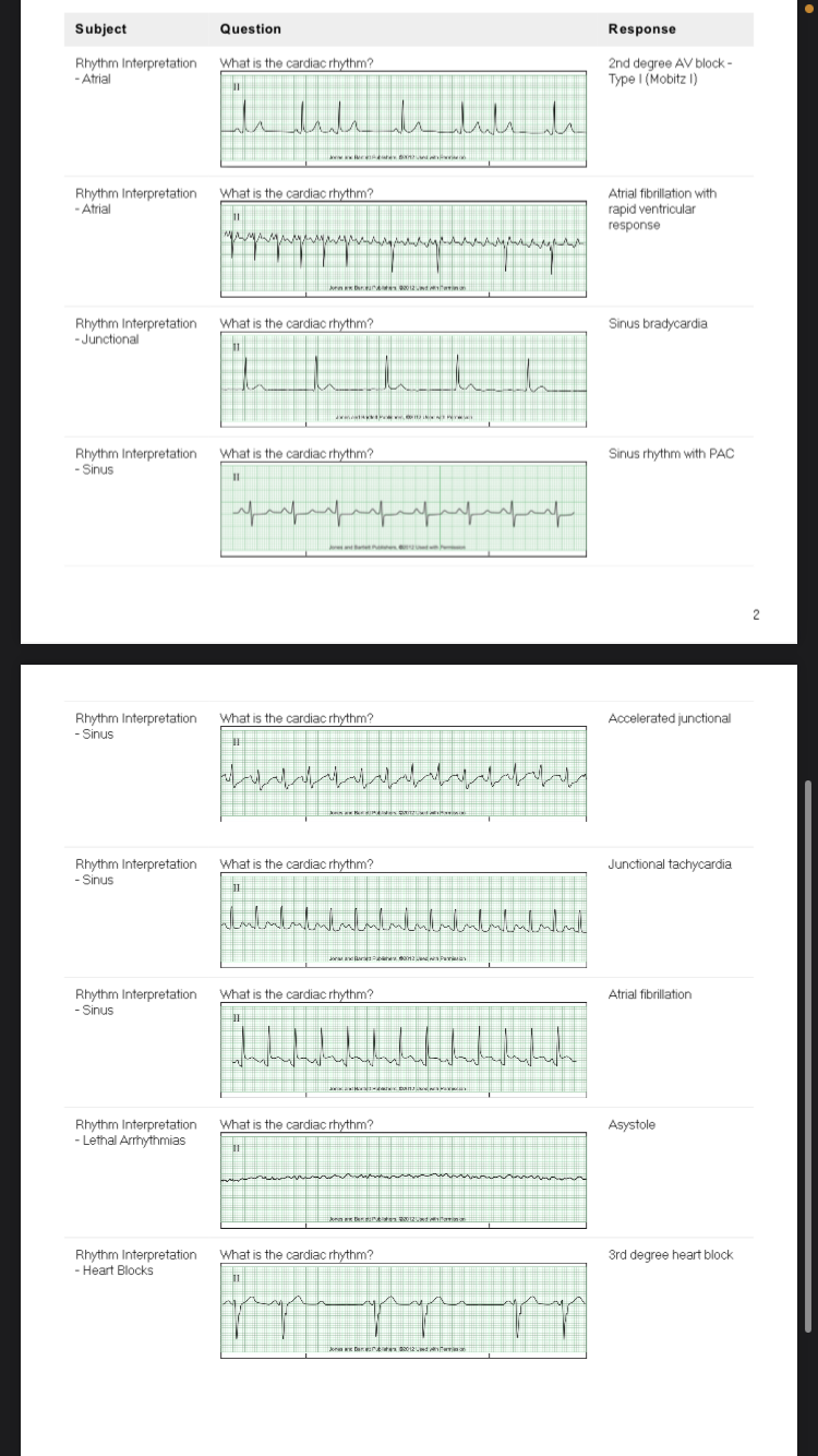 Solved How do I interpret these ekg strips correctly?