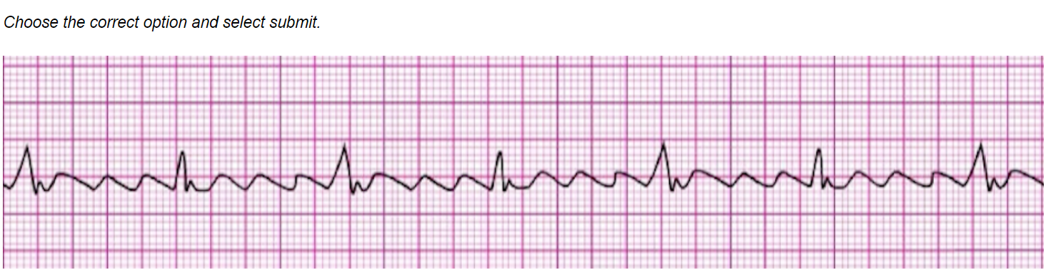 Solved H. Second-degree atrioventricular block (Mobitz I | Chegg.com