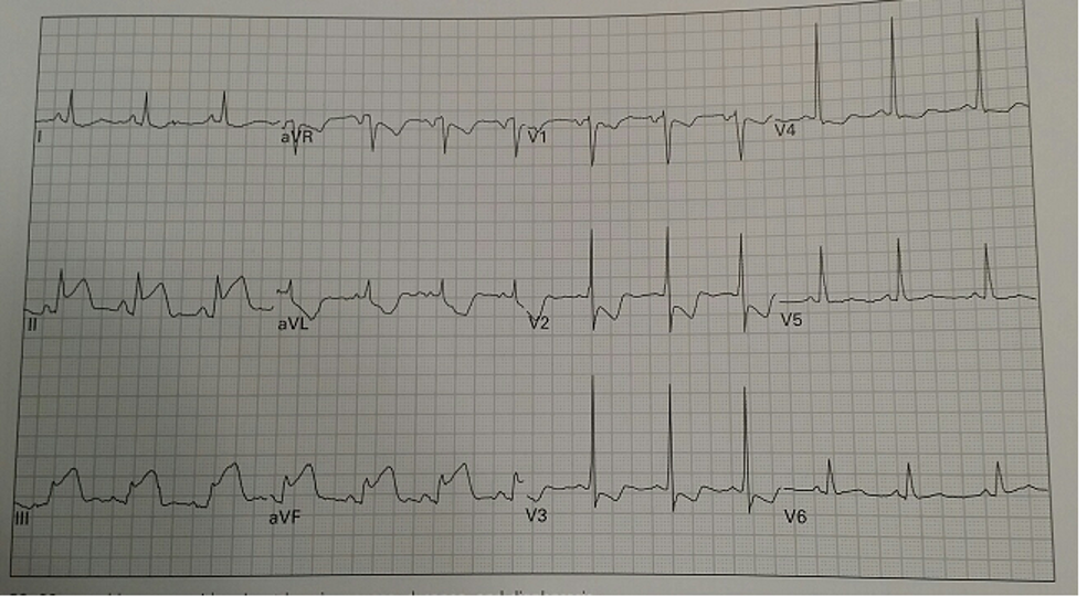 Solved Identify All 8 steps of this EKG 1. Rhythm 2. Rate 3. | Chegg.com