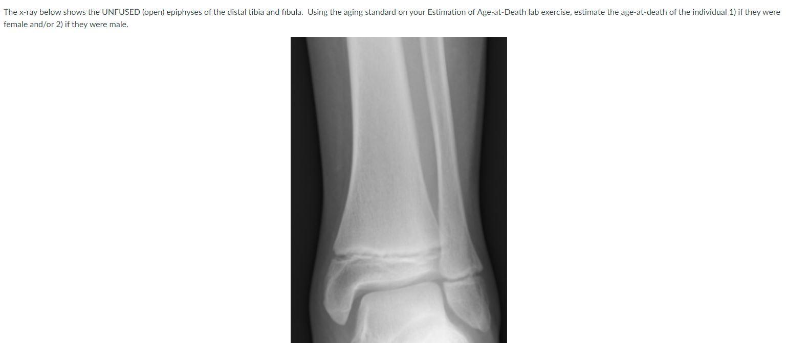 The X-ray below shows the UNFUSED (open) epiphyses of the distal tibia and fibula. Using the aging standard on your Estimatio