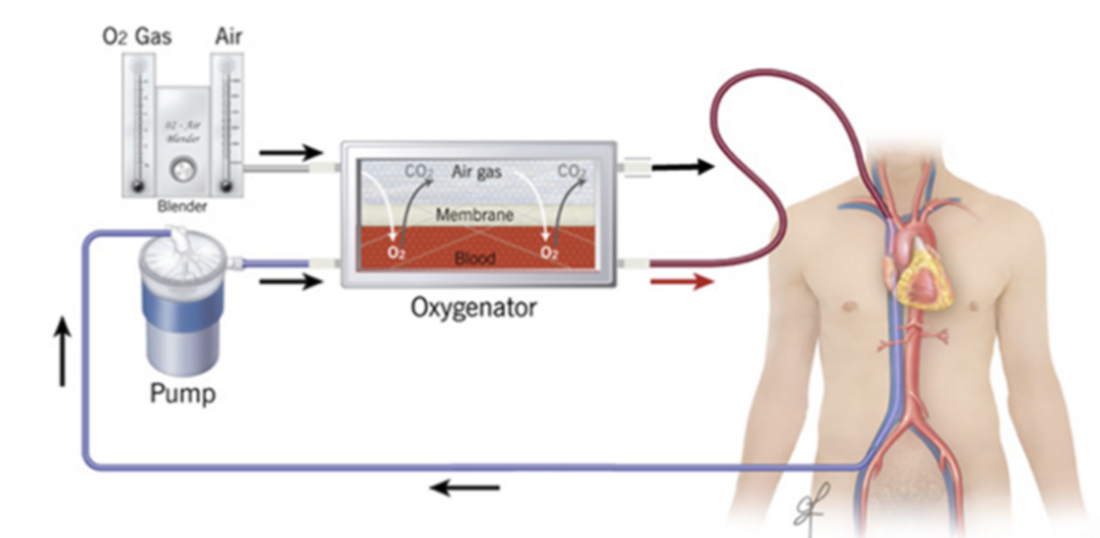 Solved Extracorporeal membrane oxygenation (ECMO) is a | Chegg.com