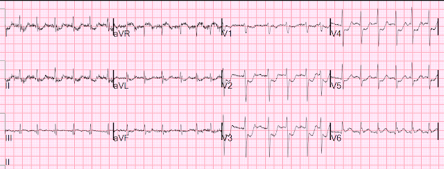 Whats the problem in this ECG? | Chegg.com