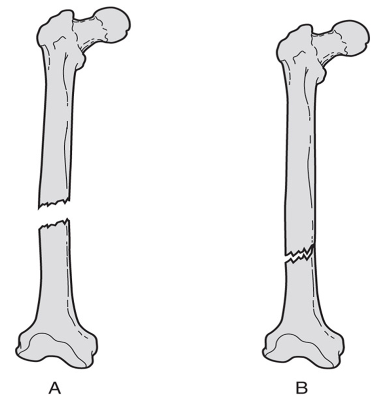 Complete Vs Incomplete Fracture