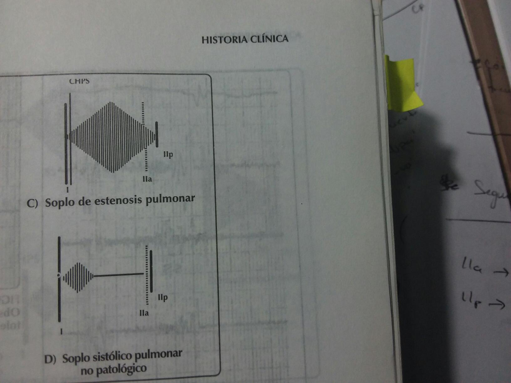 Alteraciones Semiologicas Flashcards Chegg Com La estenosis pulmonar es un defecto cardiaco congenito que afecta el corazon. alteraciones semiologicas flashcards