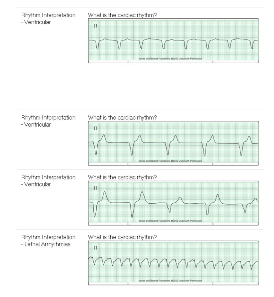 Solved Rhythm Interpretation - Ventricular Rhythm | Chegg.com