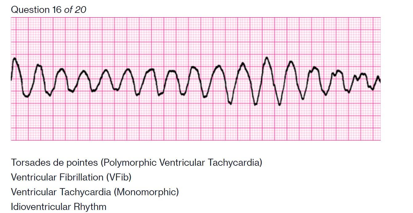 polymorphic ventricular tachycardia vs ventricular fibrillation