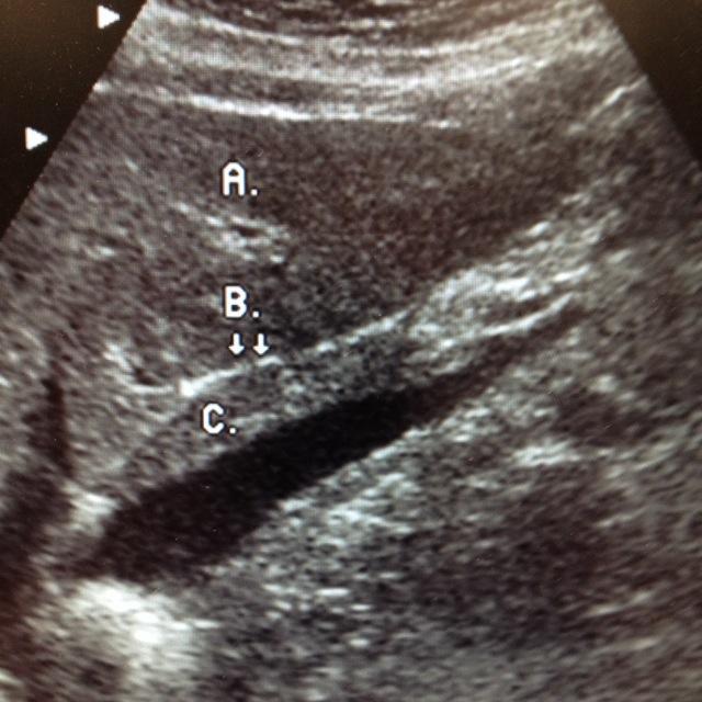 ligamentum teres ultrasound