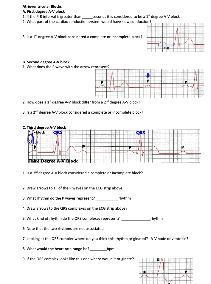 Solved Atrioventricular Blocks A. First degree A-V block 1. | Chegg.com