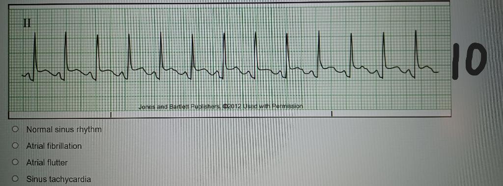 Solved Normal sinus rhythm Atrial fibrillation Atrial | Chegg.com