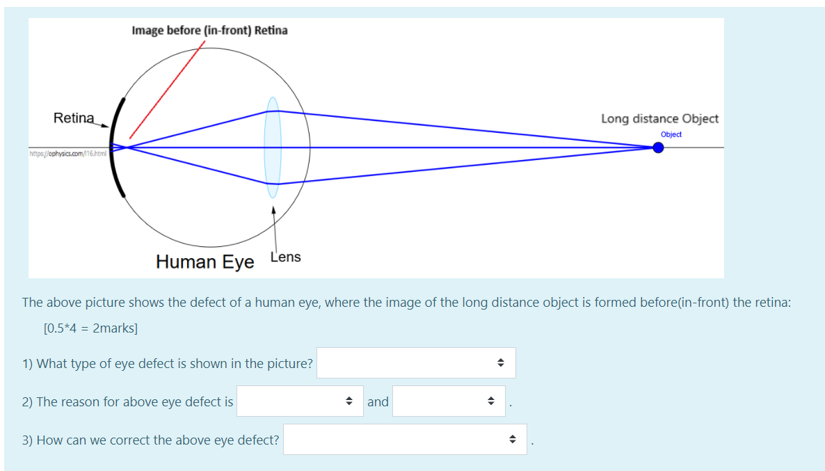 Solved Image before (in-front) Retina Retina Long distance | Chegg.com