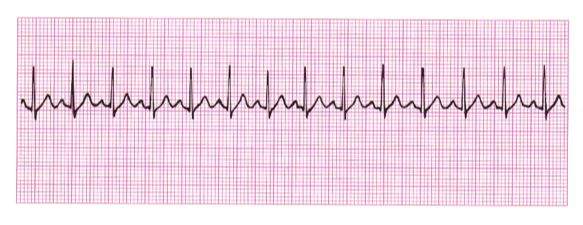 Solved 4. Using The Ekg Tracing Below, Answer The Following 