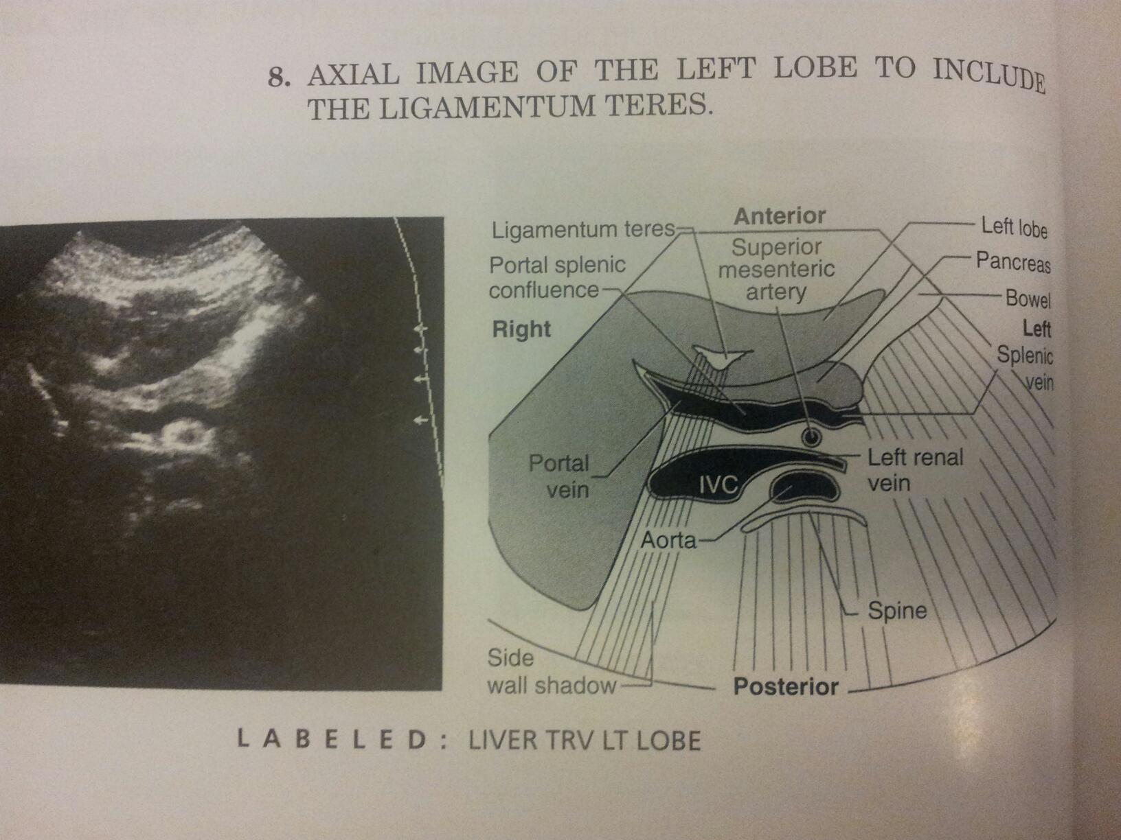 ligamentum teres ultrasound