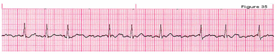 Solved Choose the letter choice that best fits the ECG strip | Chegg.com