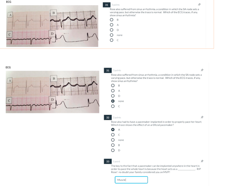 Multi Part Question Regarding A Patient And Ecg Chegg Com